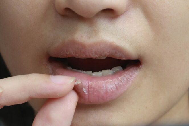 
					5 Tips Mengatasi Bibir Pecah-Pecah